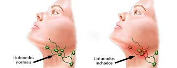 Os linfonodos ficam inchados por conta da doença e sem tratamento, os mesmos não regridem de tamanho